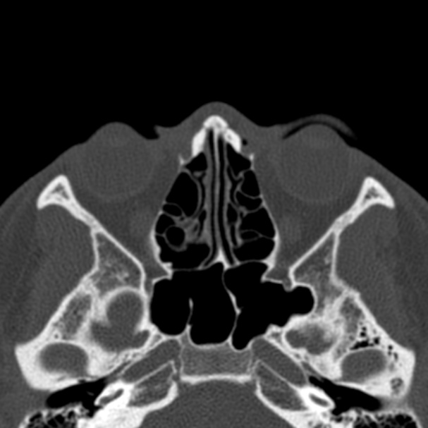 Antrochoanal polyp (Radiopaedia 33984-35202 Axial bone window 45).jpg