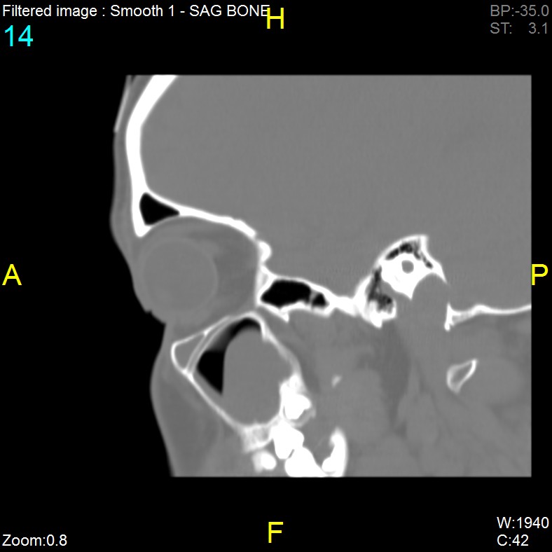 Antrochoanal polyp (Radiopaedia 65101-74094 Sagittal bone window 14).jpg