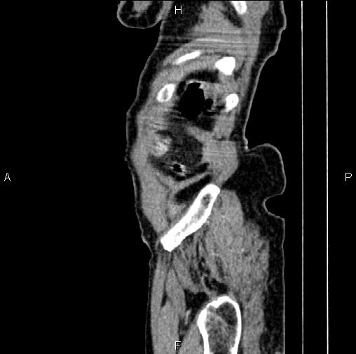 File:Aortic aneurysm and Lemmel syndrome (Radiopaedia 86499-102554 D 86).jpg