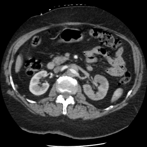 File:Aortic aneurysm and dissection - Stanford type A (Radiopaedia 36693-38261 A 58).png