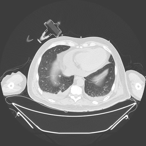 Aortic arch aneurysm (Radiopaedia 84109-99365 Axial lung window 213).jpg