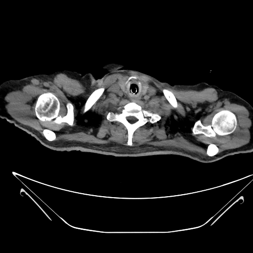 Aortic arch aneurysm (Radiopaedia 84109-99365 Axial non-contrast 13).jpg