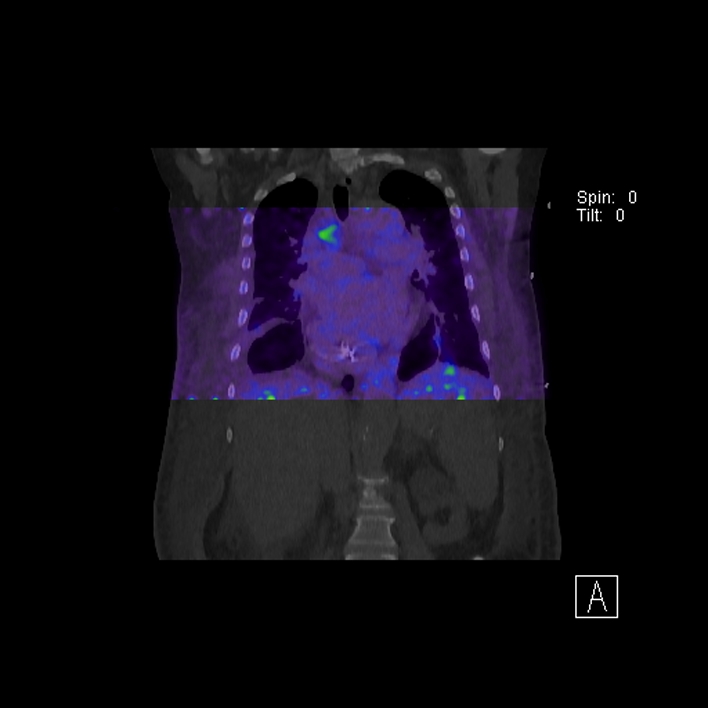 Aortic arch graft infection (FDG PET-CT) (Radiopaedia 71975-82438 D 48).jpg