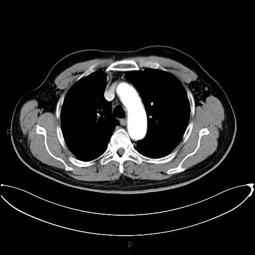 File:Aortic arch origin of left vertebral artery (Radiopaedia 46327-50737 Axial post contrast 36).jpg