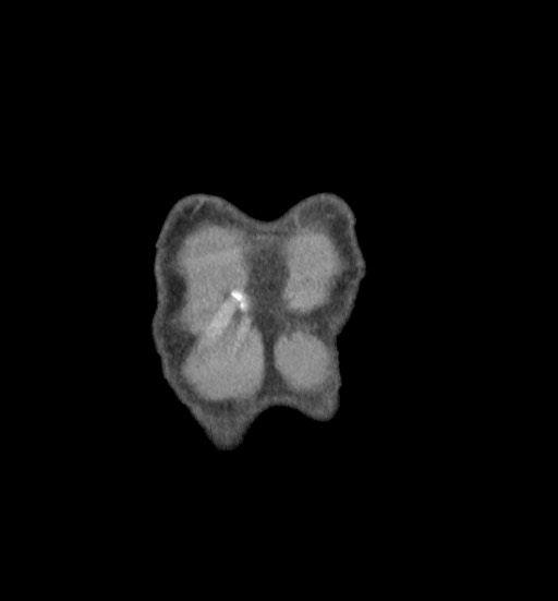 Aortic coarctation with aneurysm (Radiopaedia 74818-85828 C 4).jpg