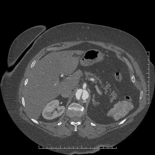 Aortic dissection- Stanford A (Radiopaedia 35729-37268 B 43).jpg