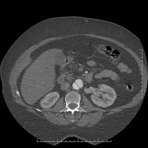 Aortic dissection- Stanford A (Radiopaedia 35729-37268 B 67).jpg