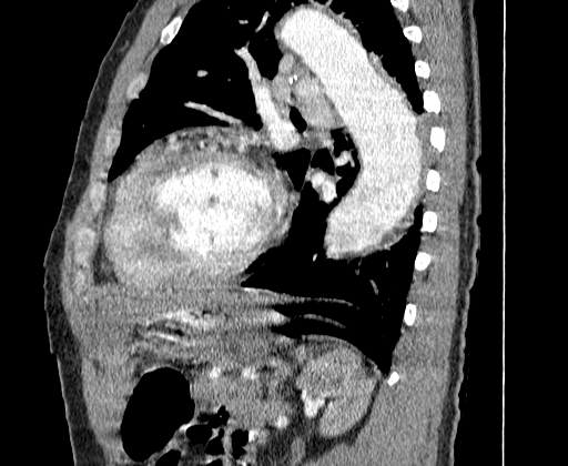 Aortic dissection - Stanford A -DeBakey I (Radiopaedia 28339-28587 C 63).jpg