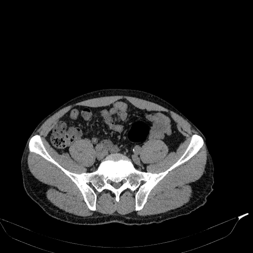 File:Aortic dissection - Stanford type A (Radiopaedia 83418-98500 Axial non-contrast 74).jpg