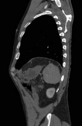 File:Aortic dissection - Stanford type B (Radiopaedia 73648-84437 C 23).jpg