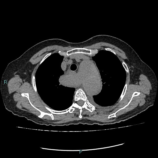 File:Aortic dissection extended to lusory artery (Radiopaedia 43686-47136 Axial non-contrast 7).jpg