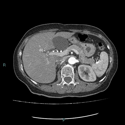 File:Aortic dissection extended to lusory artery (Radiopaedia 43686-47136 B 15).jpg