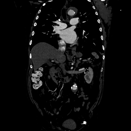 Aortic intramural hematoma (Radiopaedia 34260-35540 C 43).png