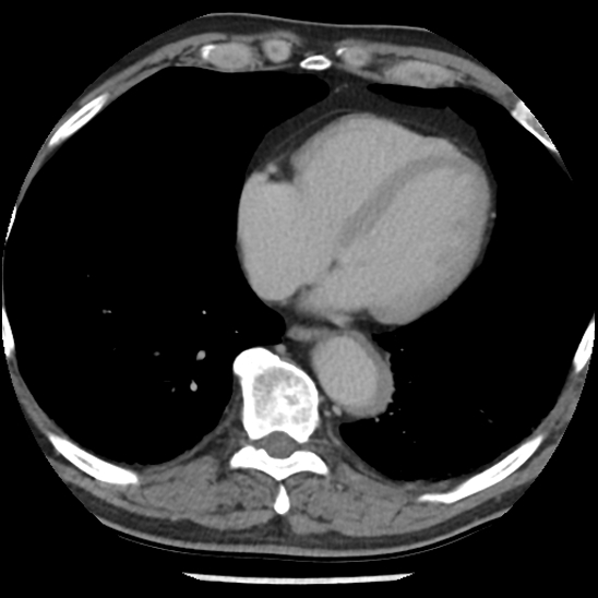 Aortic intramural hematoma (type B) (Radiopaedia 79323-92387 Axial C+ delayed 38).jpg