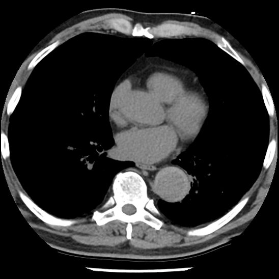Aortic intramural hematoma (type B) (Radiopaedia 79323-92387 Axial non-contrast 31).jpg