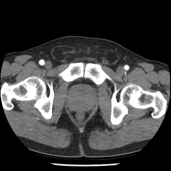 Aortic intramural hematoma (type B) (Radiopaedia 79323-92387 B 115).jpg
