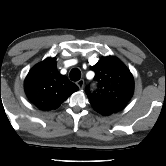 File:Aortic intramural hematoma (type B) (Radiopaedia 79323-92387 B 8).jpg