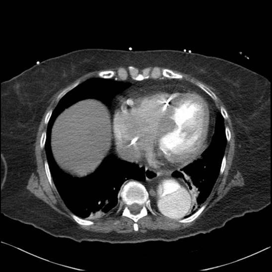 Aortic intramural hematoma with dissection and intramural blood pool (Radiopaedia 77373-89491 B 81).jpg