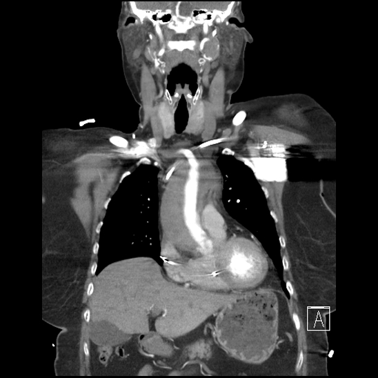 Aortic intramural hematoma with dissection and intramural blood pool (Radiopaedia 77373-89491 C 18).jpg
