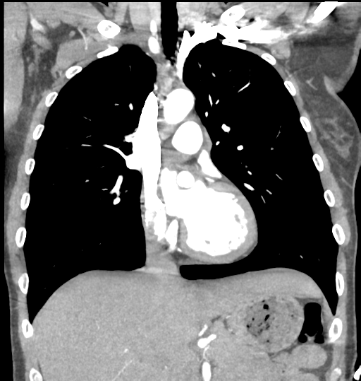 File:Aortic valve non-coronary cusp thrombus (Radiopaedia 55661-62189 C 35).png