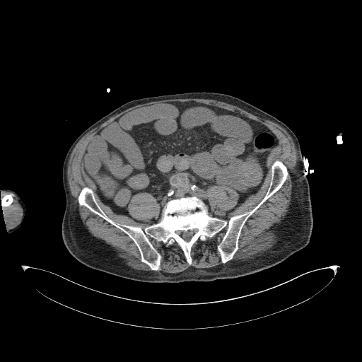 Aortoduodenal fistula (Radiopaedia 75286-86415 Axial non-contrast 49).jpg
