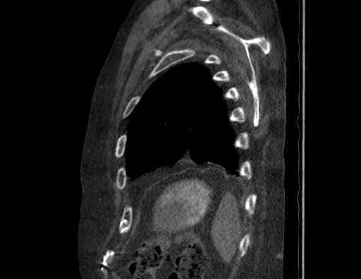 Aortoesophageal fistula with endovascular repair (Radiopaedia 73781-84592 Sagittal C+ CTPA 172).jpg