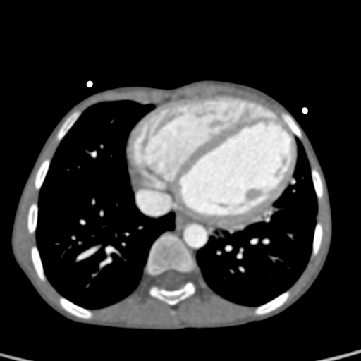 File:Aortopulmonary window, interrupted aortic arch and large PDA giving the descending aorta (Radiopaedia 35573-37074 B 65).jpg