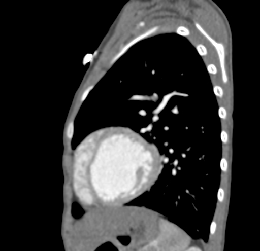 File:Aortopulmonary window, interrupted aortic arch and large PDA giving the descending aorta (Radiopaedia 35573-37074 C 43).jpg