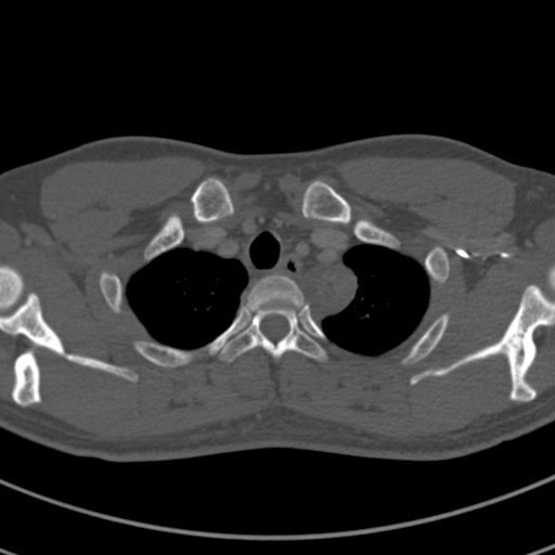 Apical lung mass mimic - neurogenic tumor (Radiopaedia 59918-67521 Axial bone window 11).jpg