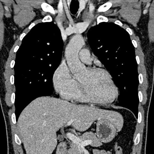 Apical lung mass mimic - neurogenic tumor (Radiopaedia 59918-67521 B 53).jpg