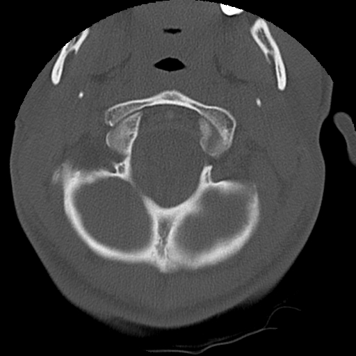 Apical pneumothorax on cervical spine CT (Radiopaedia 45343-49368 Axial bone window 9).jpg