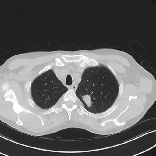 Apical pulmonary metastasis (Radiopaedia 46338-50754 Axial non-contrast 14).png