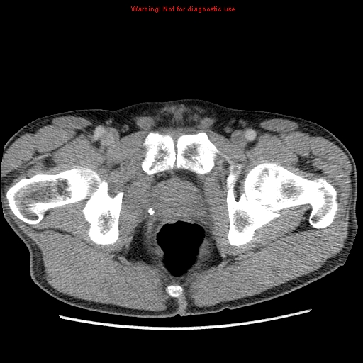 File:Appendicitis and renal cell carcinoma (Radiopaedia 17063-16760 A 57).jpg
