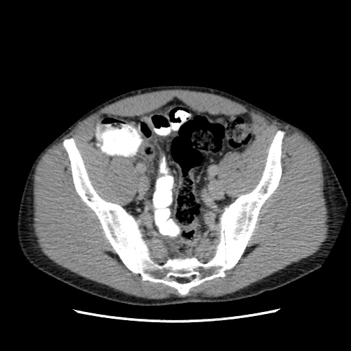 Appendicitis complicated by post-operative collection (Radiopaedia 35595-37113 A 61).jpg