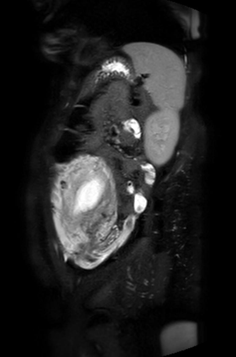 Appendicitis in gravida (MRI) (Radiopaedia 89433-106395 Sagittal T2 SPAIR 15).jpg