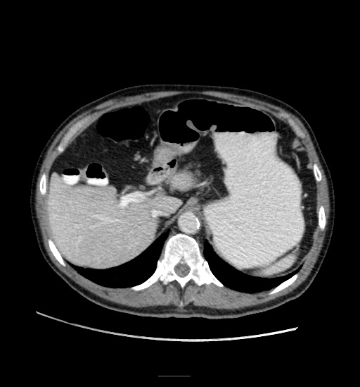 File:Appendicitis with localized perforation and abscess formation (Radiopaedia 49035-54130 A 25).jpg