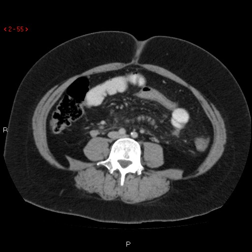 File:Appendicitis with microperforation- promontoric type (Radiopaedia 27268-27442 C 43).jpg