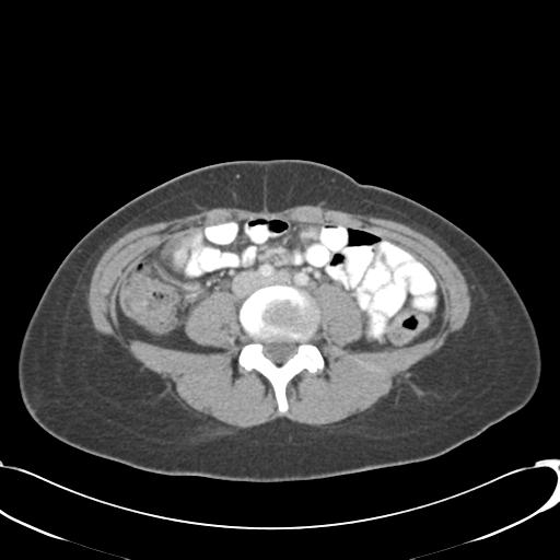 File:Appendicitis with minimal stranding but appendicolith (Radiopaedia 29035-29397 A 51).jpg