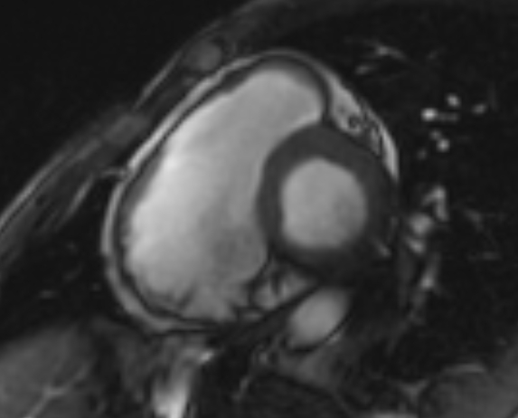 Arrhythmogenic right ventricular cardiomyopathy (Radiopaedia 69564-79464 short axis cine 207).jpg