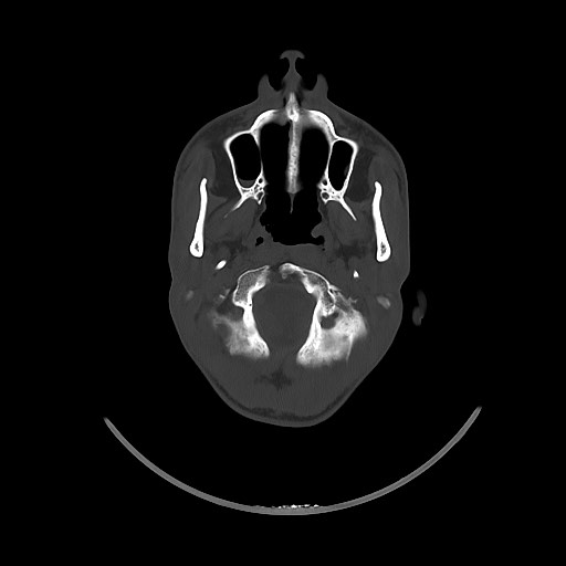 Arrow injury to the brain (Radiopaedia 72101-82607 Axial bone window 49).jpg