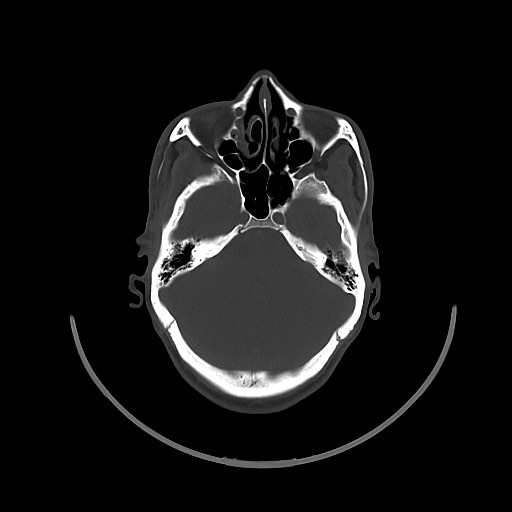 Arrow injury to the brain (Radiopaedia 72101-82607 Axial bone window 59).jpg