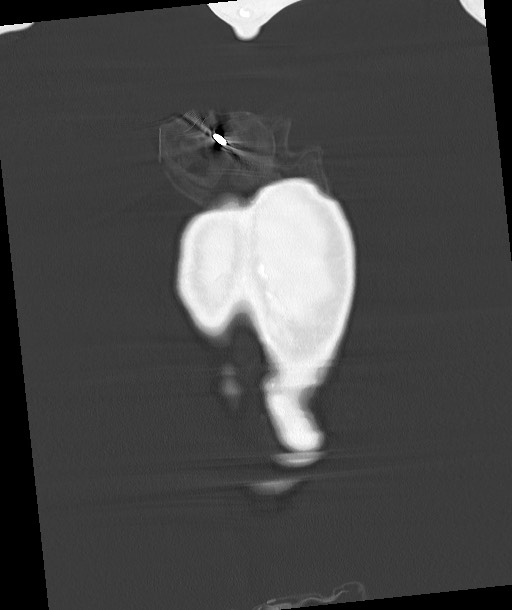 Arrow injury to the chest (Radiopaedia 85367-100975 Coronal lung window 33).jpg