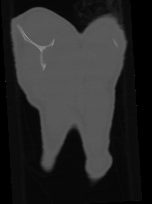 Arrow injury to the neck (Radiopaedia 75225-86323 Coronal bone window 114).jpg