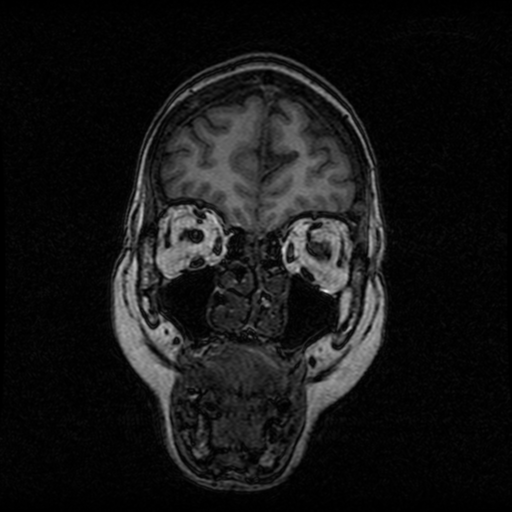 Arteriovenous malformation (cerebral) (Radiopaedia 40070-42580 Coronal T1 52).png