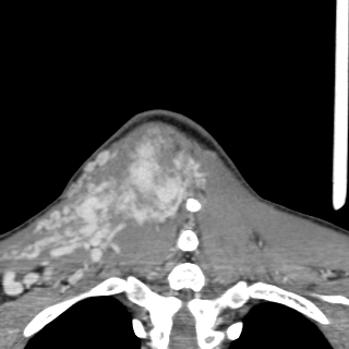 Arteriovenous malformation of the neck (Radiopaedia 53935-60062 D 53).jpg