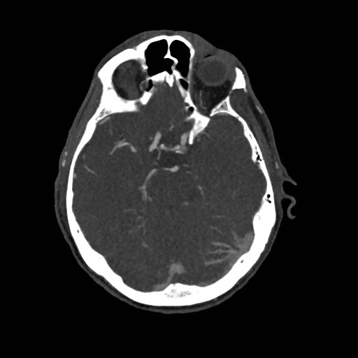 File:Artery of Percheron infarct (Radiopaedia 48088-52894 A 126).jpg