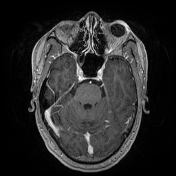 File:Artery of Percheron infarction (Radiopaedia 27975-28230 Axial T1 C+ fat sat 32).jpg