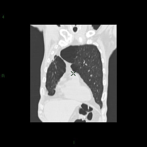 File:Aspergilloma (Radiopaedia 14842-14787 Coronal lung window 8).jpg