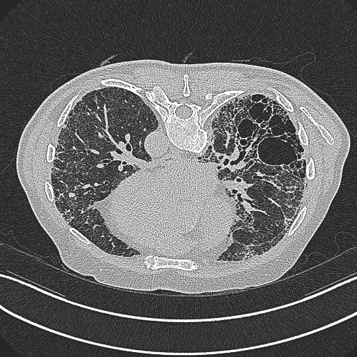 File:Aspergilloma on background pulmonary fibrosis (Radiopaedia 60942-68757 Axial lung window 13).jpg