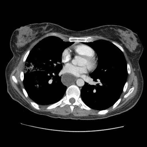 Aspiration pneumonia secondary to laparoscopic banding (Radiopaedia 18345-18183 A 29).jpg